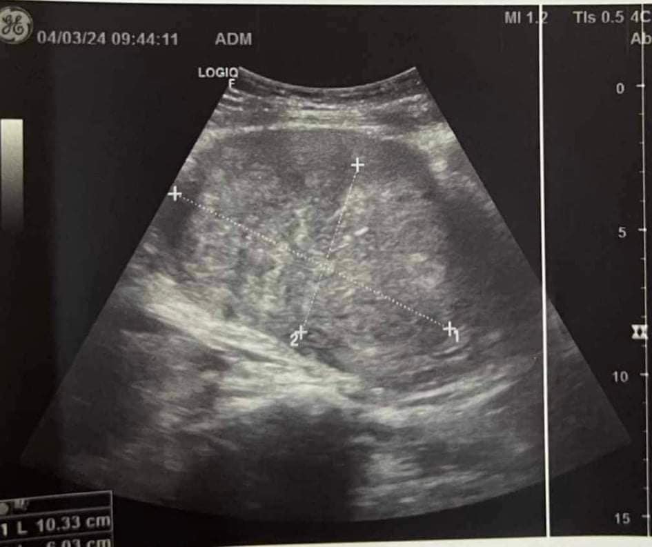 Hình 2: Hình ảnh siêu âm ổ bụng U xơ tử cung